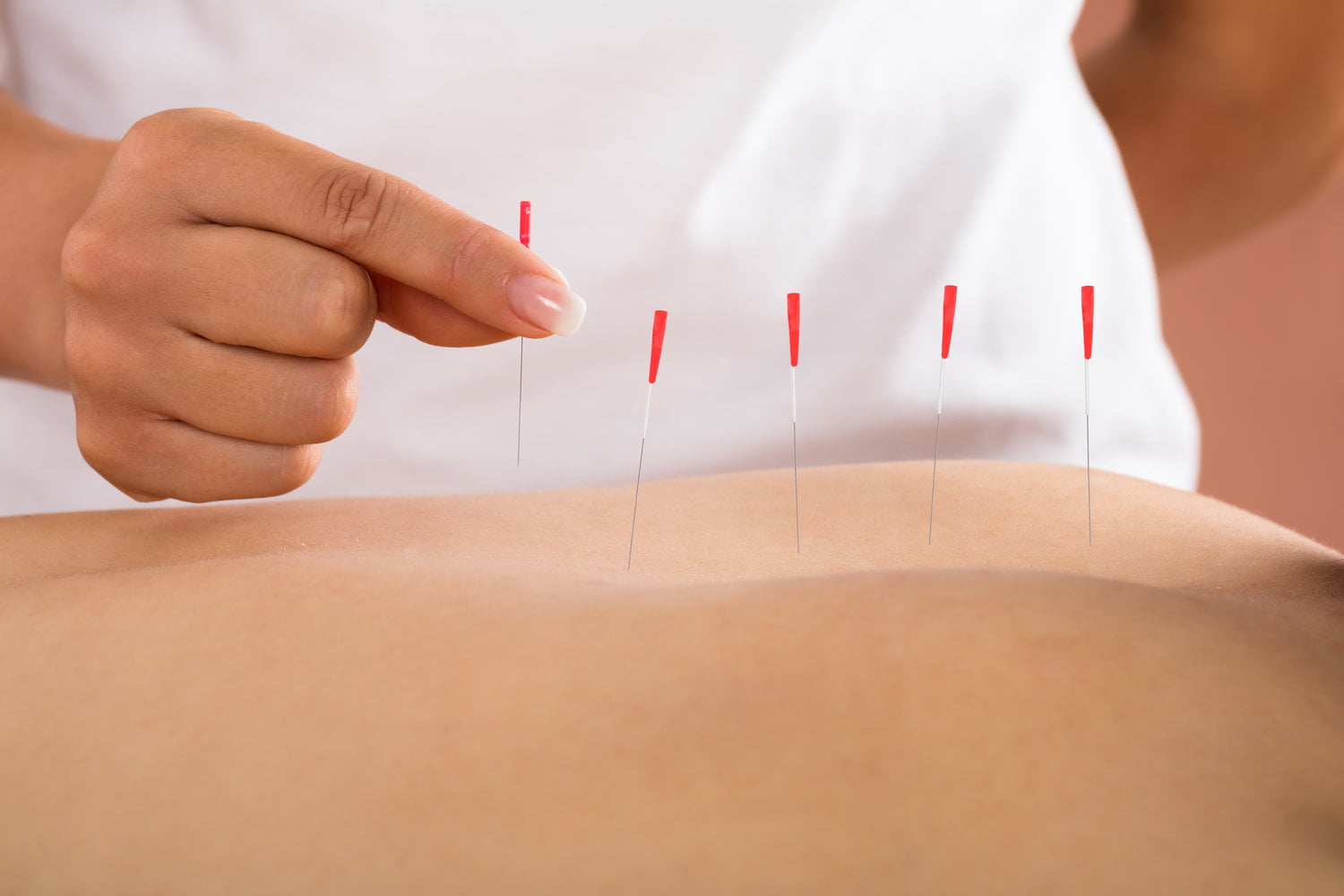 Dry needling / Ultrasound dry needling