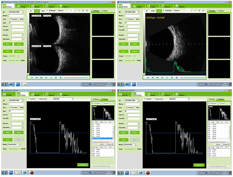 The Ophthalmic Ultrasound Scanner: Vsono-OP1 provides A/B Scan with normal, vitreous body enhancement, retina observation mode, mainly used for diagnosis of intraocular diseases, display the location, shape range of the focus of infection and the relationship with the surrounding tissue. Can be diagnosed with vitreous opacity, retinal detachment, eye base tumors, etc. eye diseases. A scan is used to measure anterior chamber depth, lens thickness, axial length, calculate diopter of implant IOL as well.