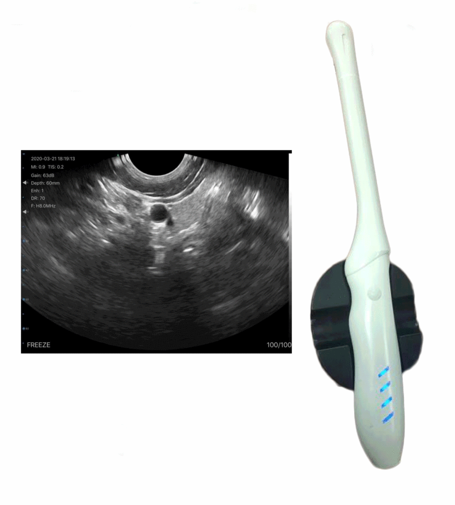 The Wireless Transvaginal Ultrasound: Vsono-TVU2 also called a wireless endovaginal ultrasound, is a Color doppler type of pelvic ultrasound used by doctors to examine female reproductive organs. This includes the uterus, fallopian tubes, ovaries, cervix, and vagina.